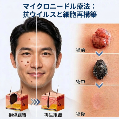 🧑‍⚕️PuraCure® 2-in-1 マイクロニードル＆ハイドロコロイドパッチ🍀| 盛り上がったホクロ・ニキビ・扁平イボ・スキンタッグのケアに | シワ・ニキビ跡・肌の色ムラをケア | 目立たない透明パッチ（顔・体用）