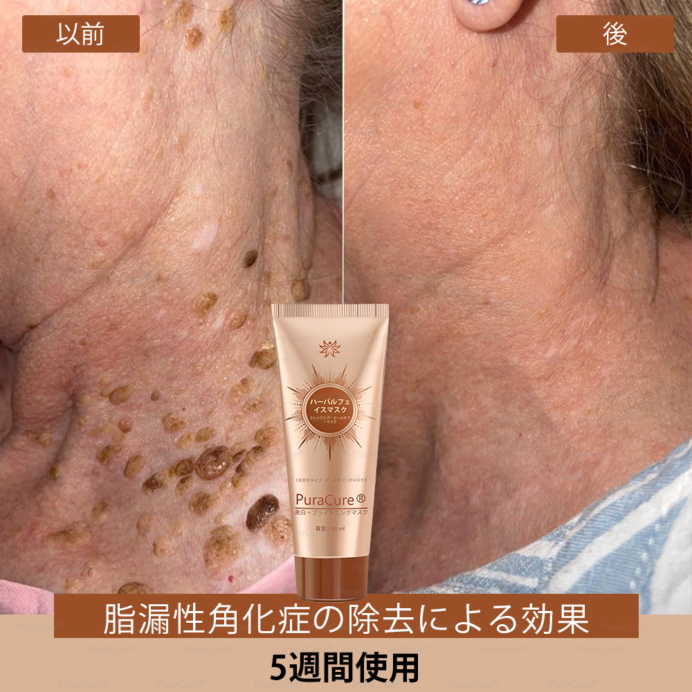 🧑‍⚕️PuraCure® 美白・スポットケアフェイスマスク【顔・ボディ兼用】天然由来成分配合で、シミ・そばかす・日焼けによるシミを長期間ケア✨