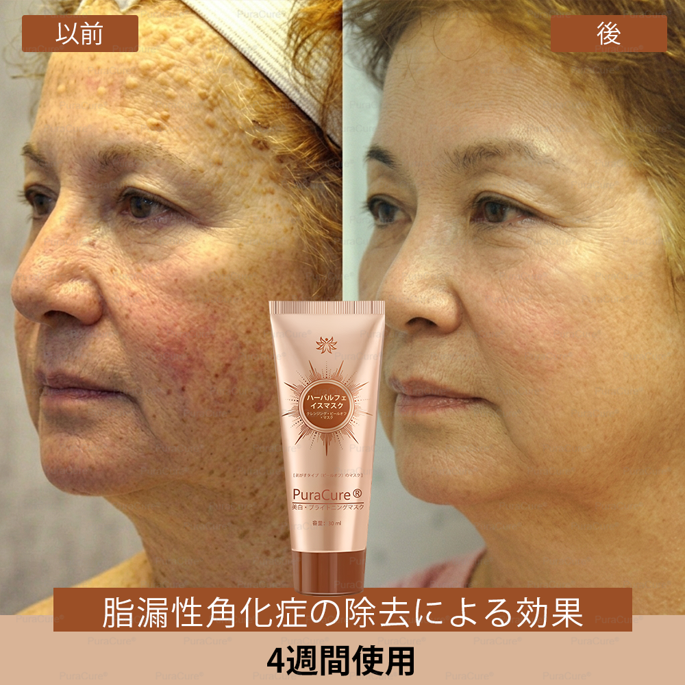 🧑‍⚕️PuraCure® 美白・スポットケアフェイスマスク【顔・ボディ兼用】天然由来成分配合で、シミ・そばかす・日焼けによるシミを長期間ケア✨