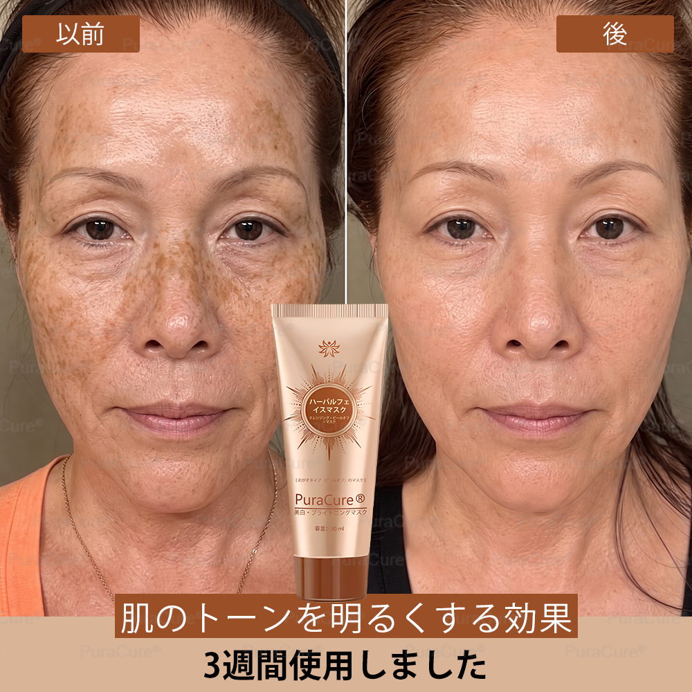 🧑‍⚕️PuraCure® 美白・スポットケアフェイスマスク【顔・ボディ兼用】天然由来成分配合で、シミ・そばかす・日焼けによるシミを長期間ケア✨