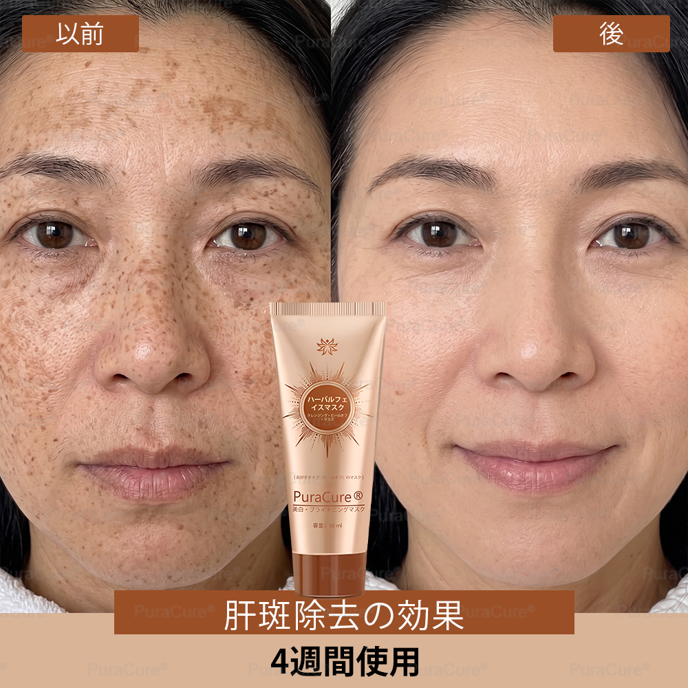 🧑‍⚕️PuraCure® 美白・スポットケアフェイスマスク【顔・ボディ兼用】天然由来成分配合で、シミ・そばかす・日焼けによるシミを長期間ケア✨