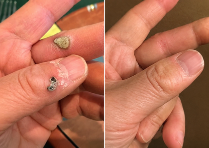 🧑‍⚕️PuraCure® 2-in-1 マイクロニードル＆ハイドロコロイドパッチ🍀| 盛り上がったホクロ・ニキビ・扁平イボ・スキンタッグのケアに | シワ・ニキビ跡・肌の色ムラをケア | 目立たない透明パッチ（顔・体用）